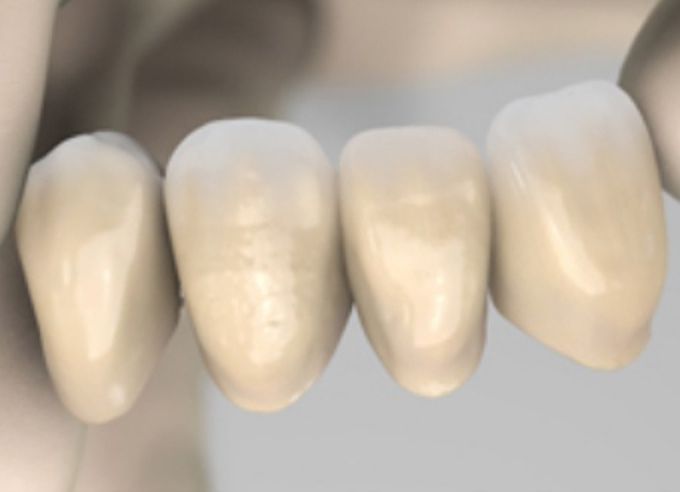 Temporary Crown Material