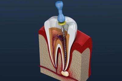 Endodontics