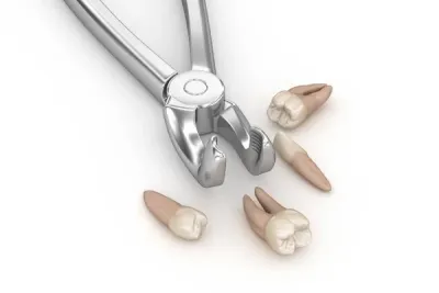 Extraction Forceps