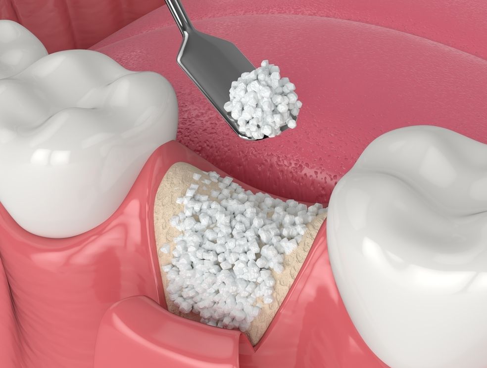 Bone Graft