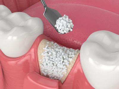 Bone Graft