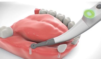 Implant Detector