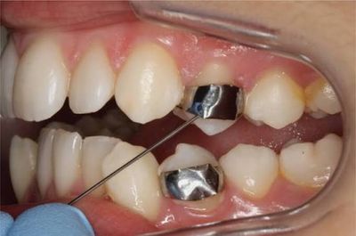 PreMolar Bands