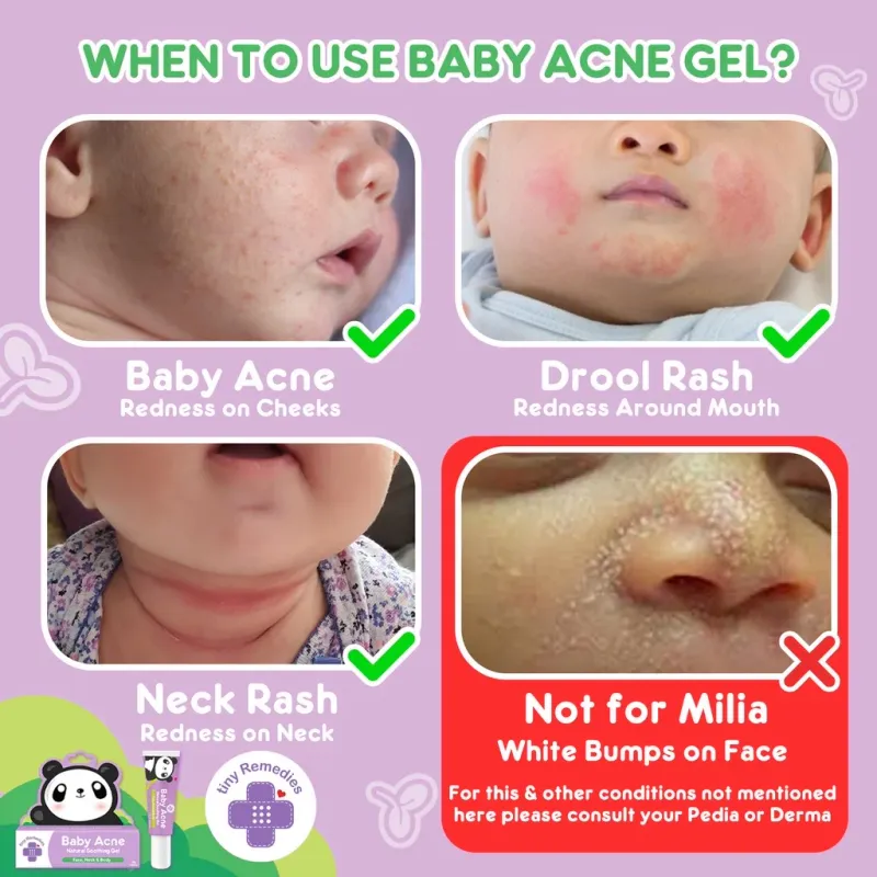Tiny Buds Baby Naturals Tiny Buds Baby Acne Soothing gel (20g)