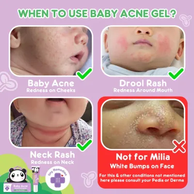Tiny Buds Baby Naturals Tiny Buds Baby Acne Soothing gel (20g)