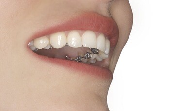 Ortodoncia lingual y autoligado