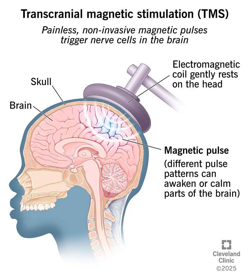 Transcranial Magnetic Stimulation (TMS)