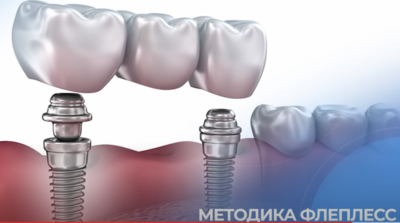 Какие бывают методы имплантации зубов