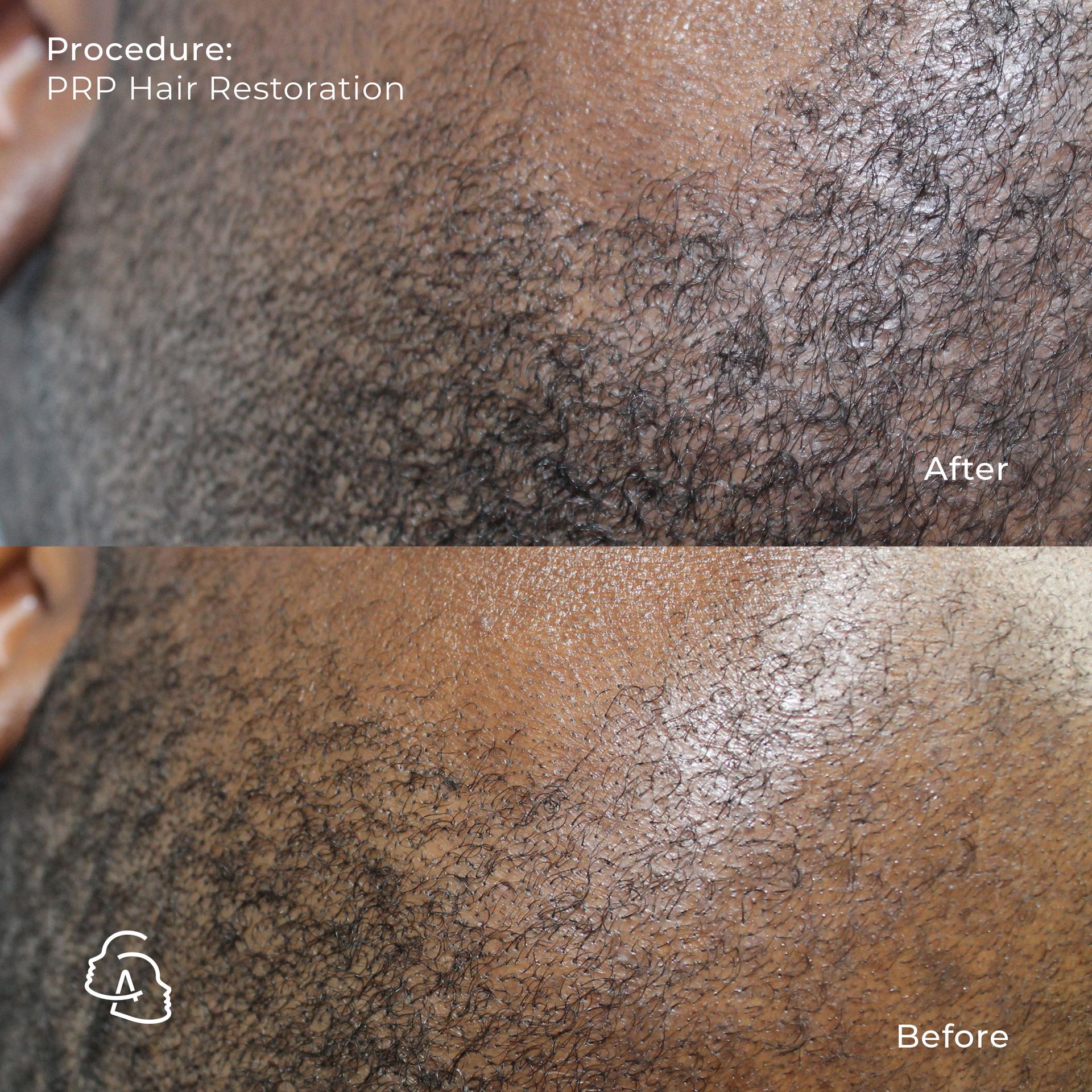 PRP Hair Rejuvenation