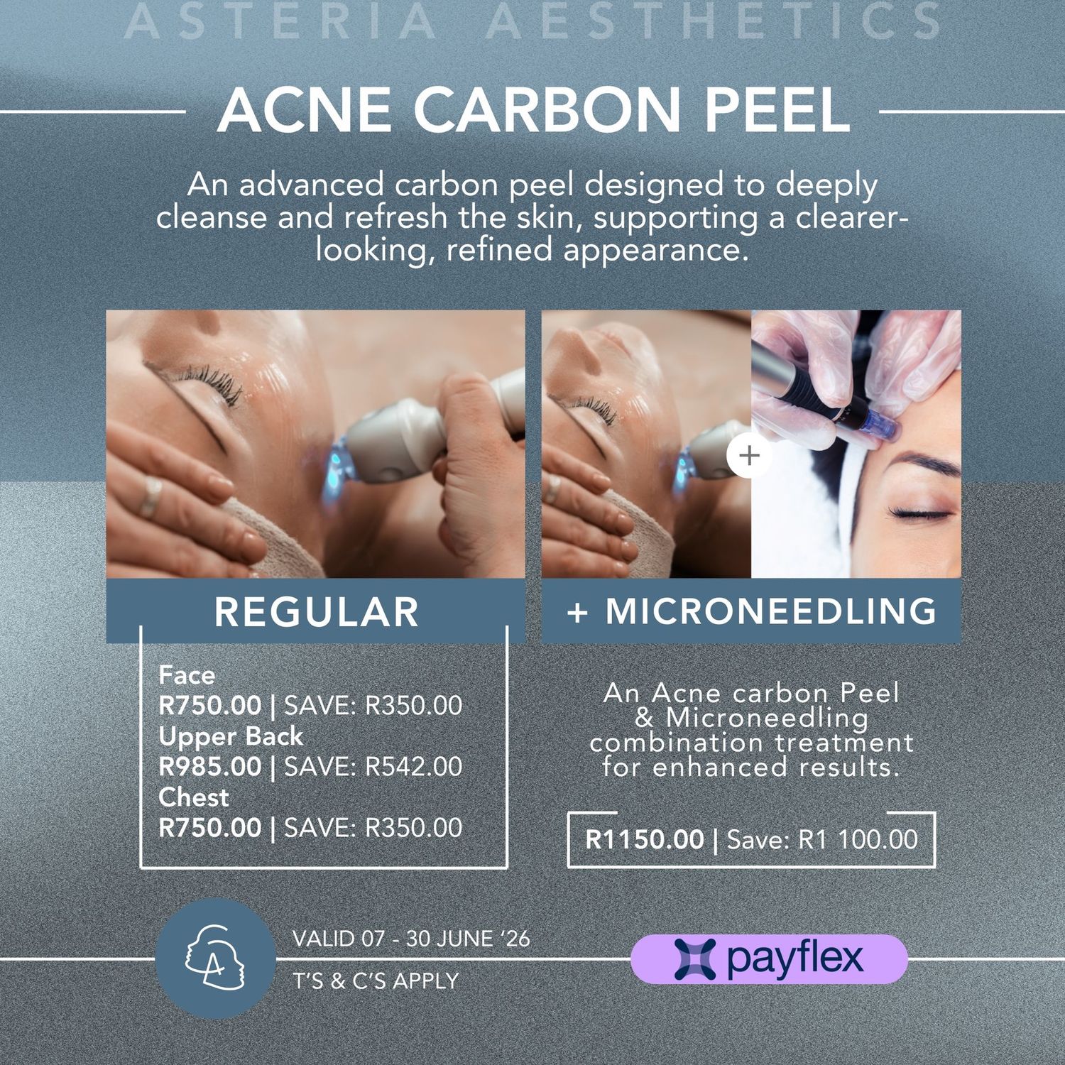 Acne Carbon Peeling Laser Treatment Upper Back