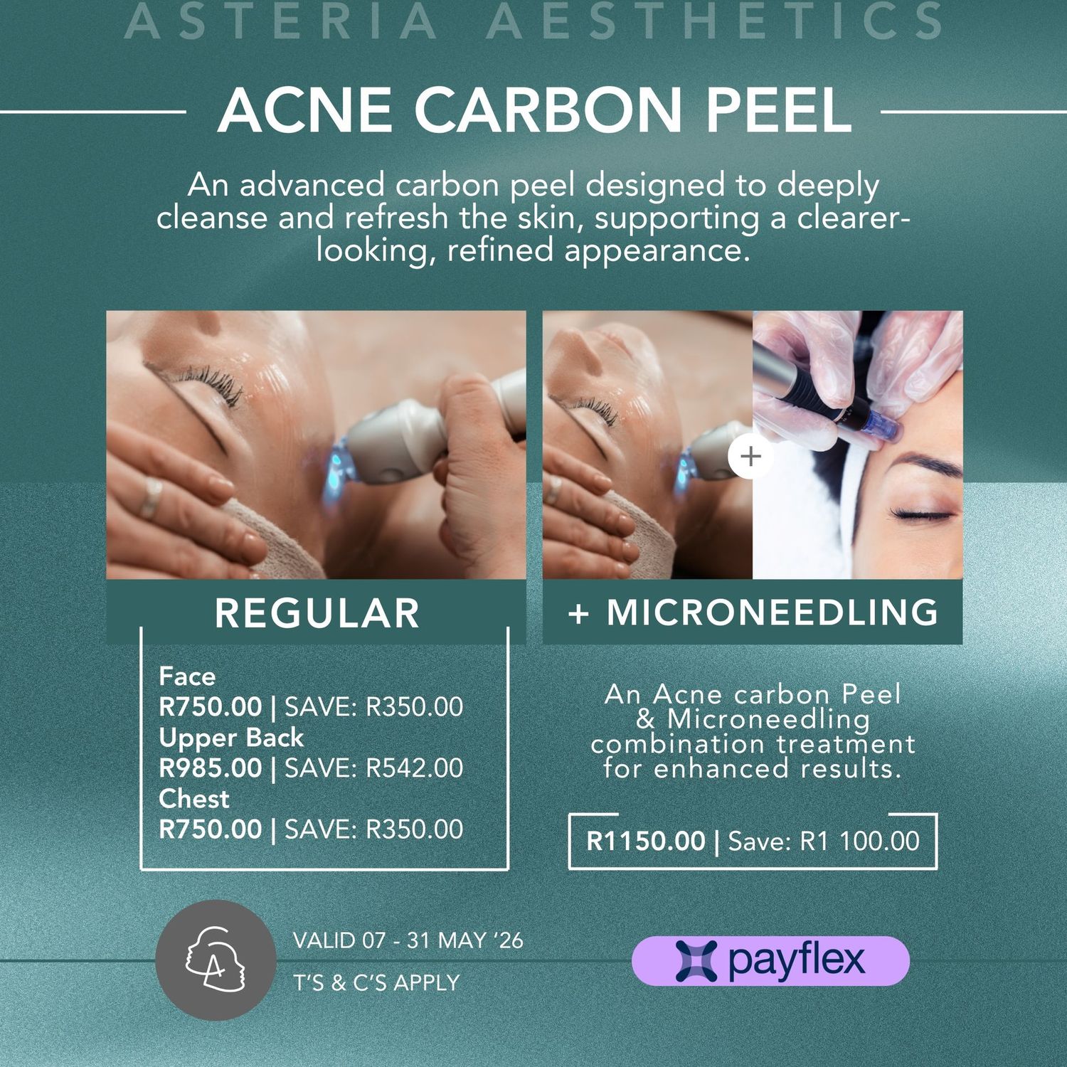 Acne Carbon Peeling Laser Treatment Chest Acne Carbon Peeling Laser Treatment Chest