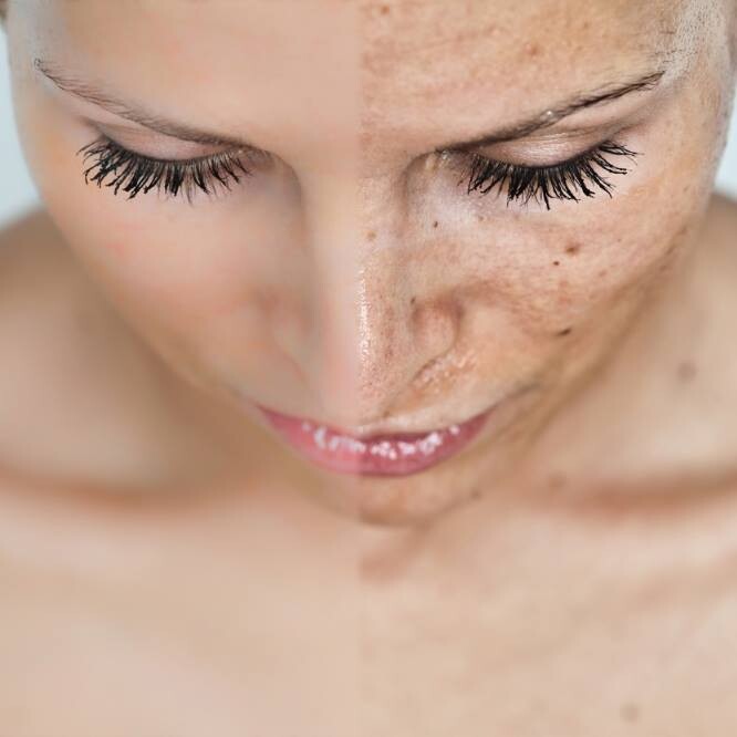 Fall Beauty Sale - IPL Photofacial - Sun Spot Removal - Face - MEMBER*