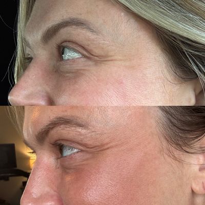 Microneedling Device + FREE LINE CORRECTOR