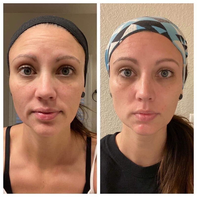 Face Lift Kit