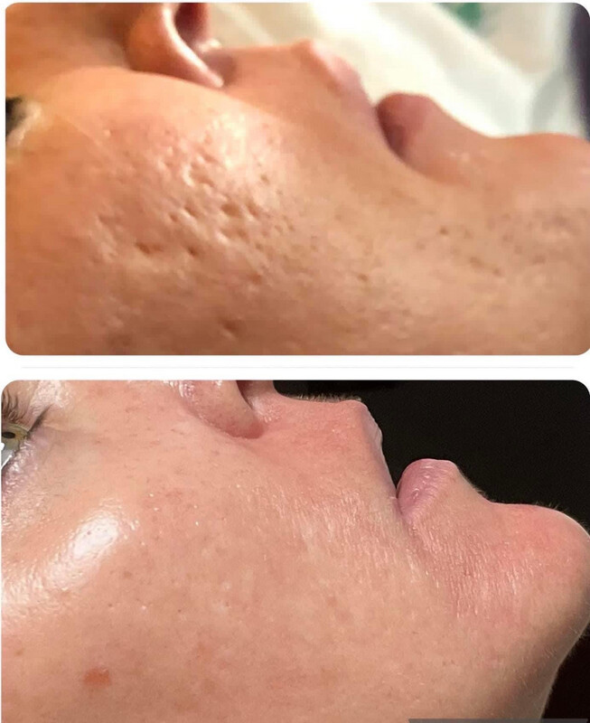Chemical Peel Kit