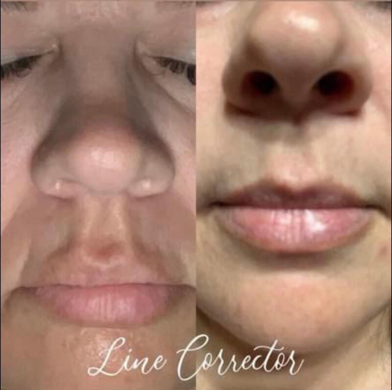 Line Corrector