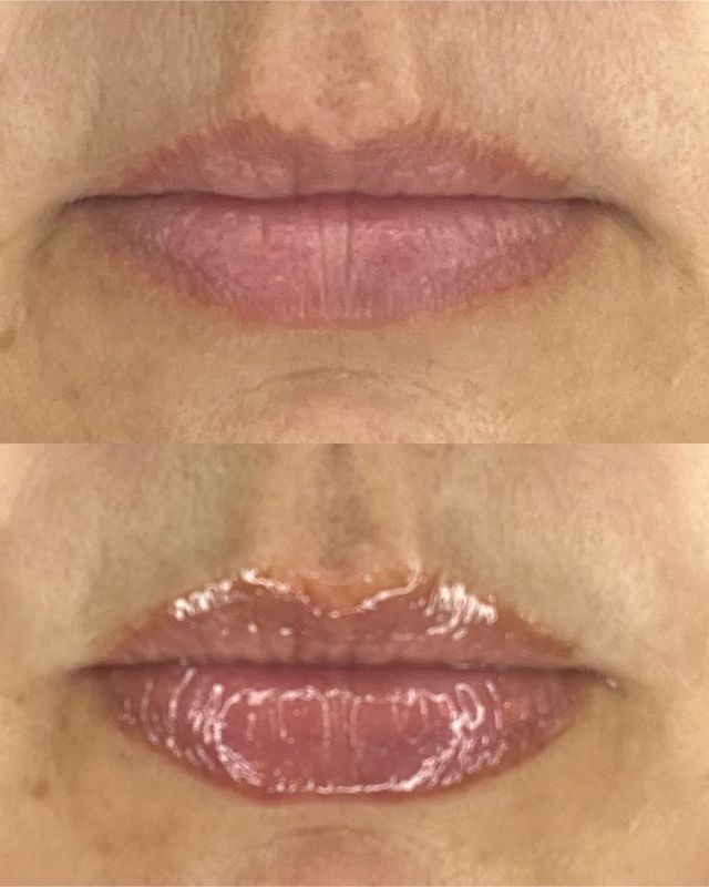 Peptide Lip Pout