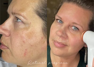 RETINOL PEPTIDES