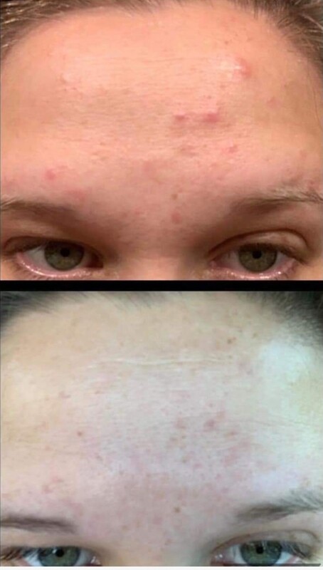Blemish Treatment