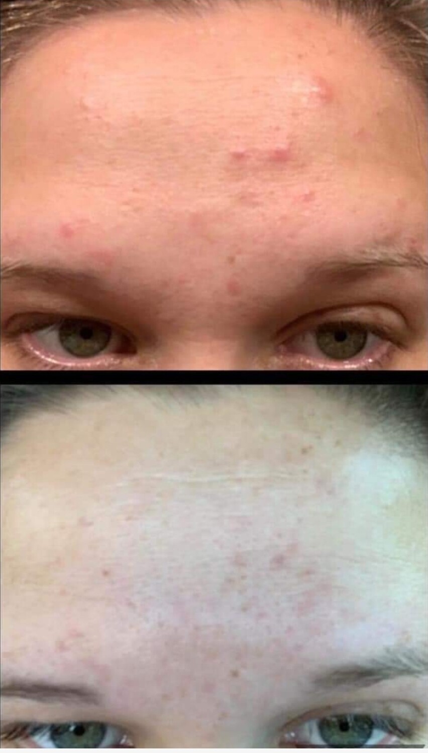 Blemish Treatment