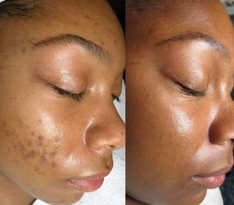 Facial Peel
