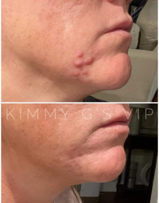 Acne Control