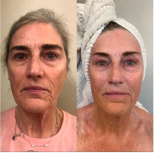 Microneedling Bundle