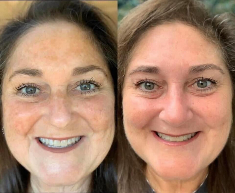 AHA Facial Peel