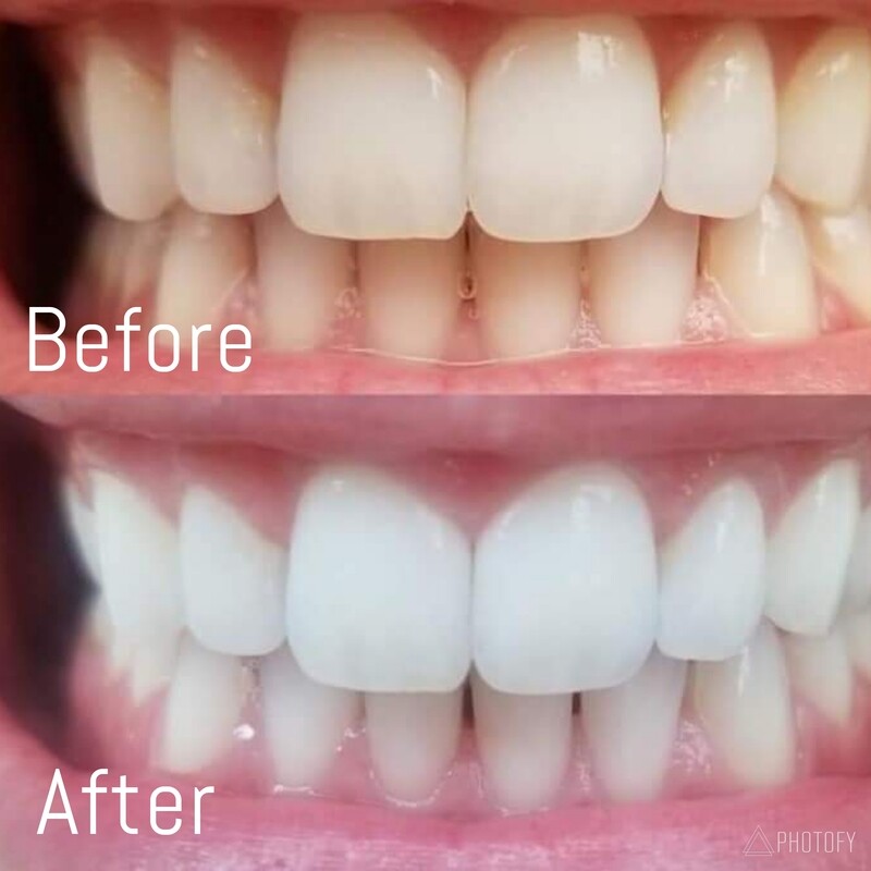 Whitening Toothpaste
