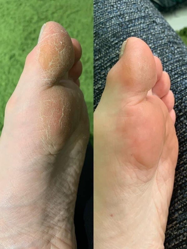 Sole Solutions Foot Treatment