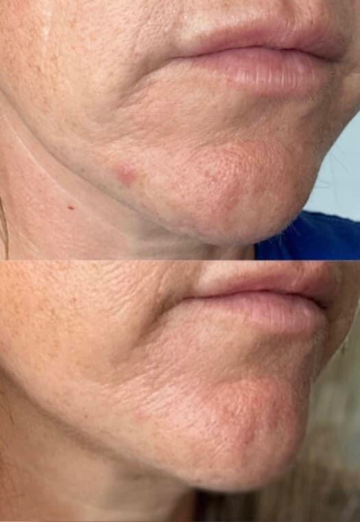 Blemish Serum