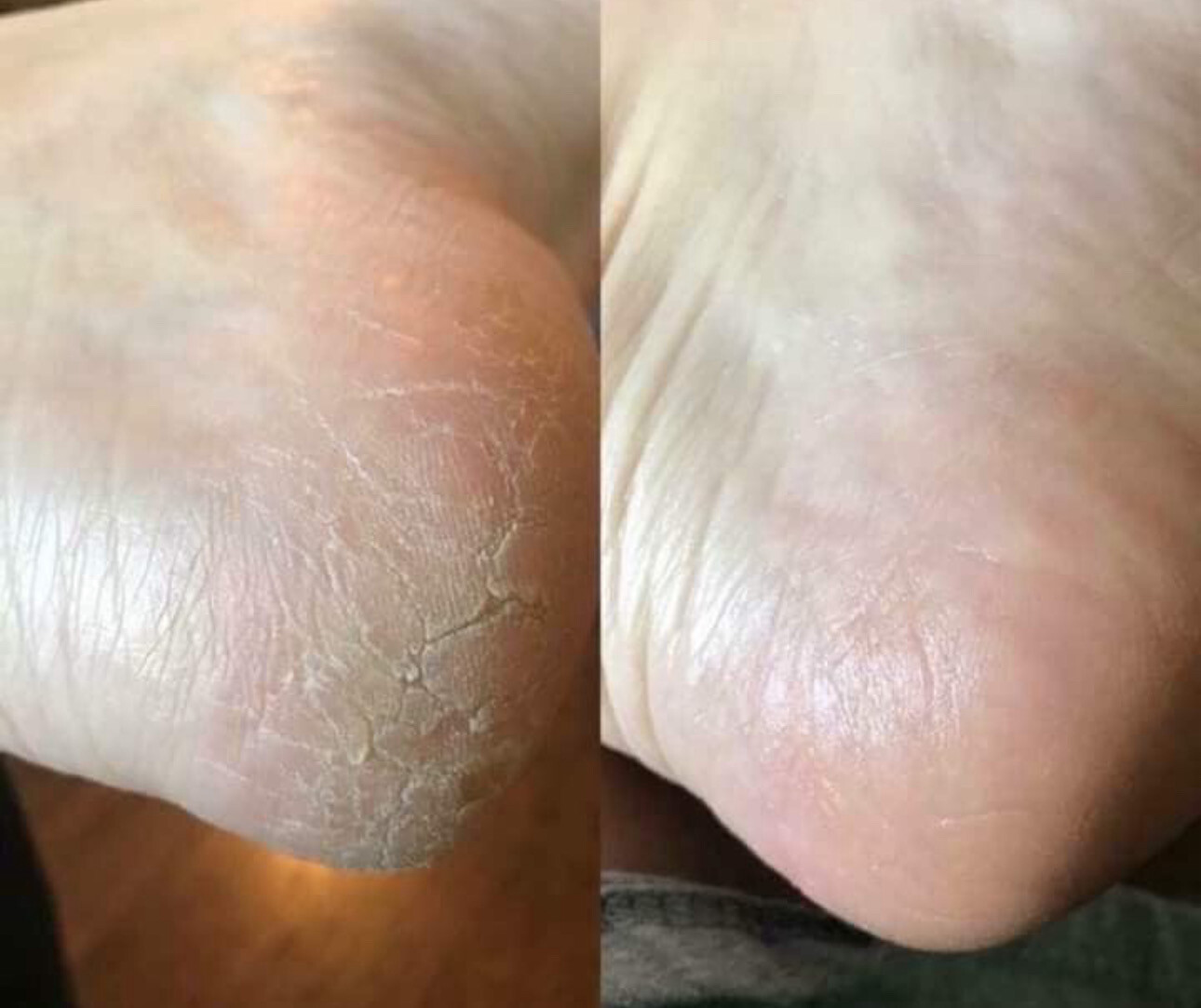 Healing Foot cream