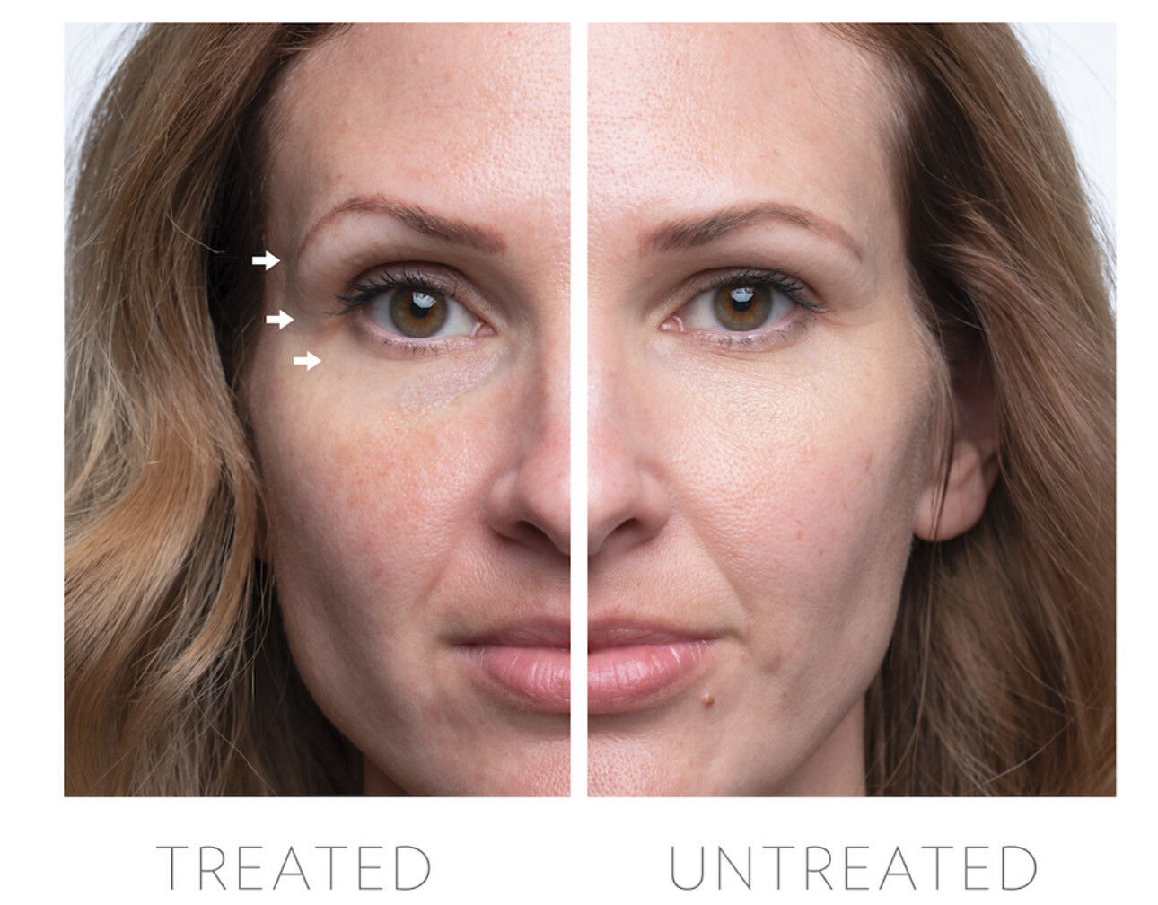 Rose Gold Eye Attachment Set For LUMI IO