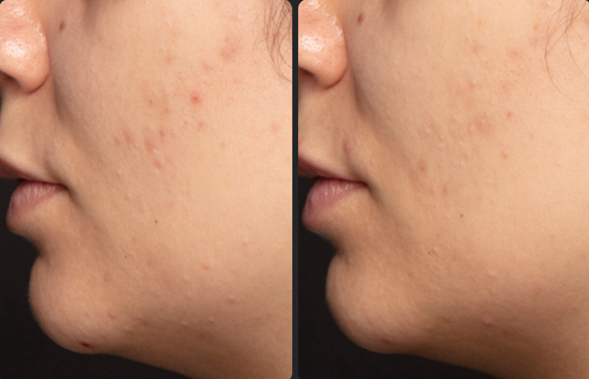 Blemish Serum!