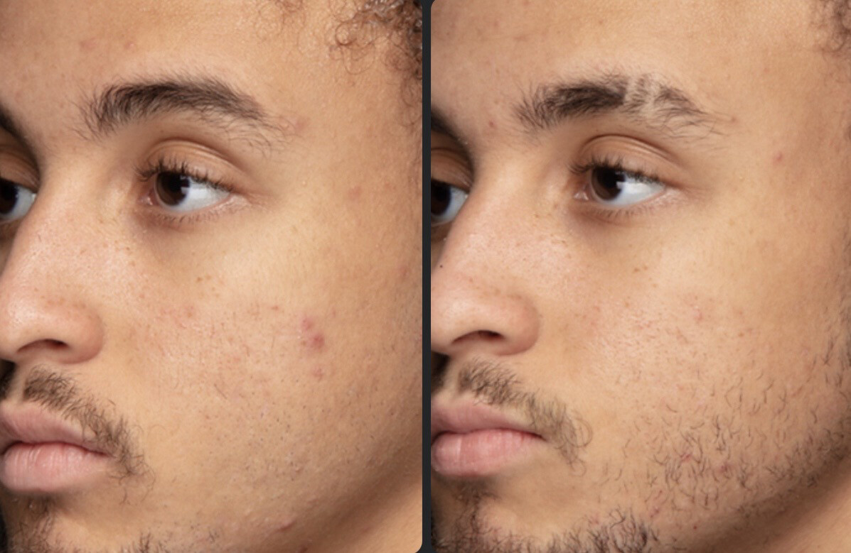 Blemish Serum!