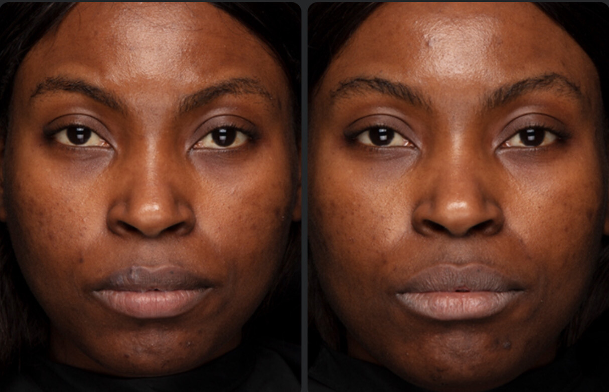 Blemish Serum!