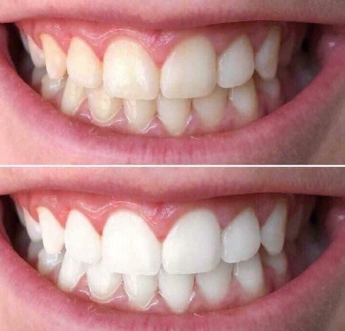Whitening Toothpaste