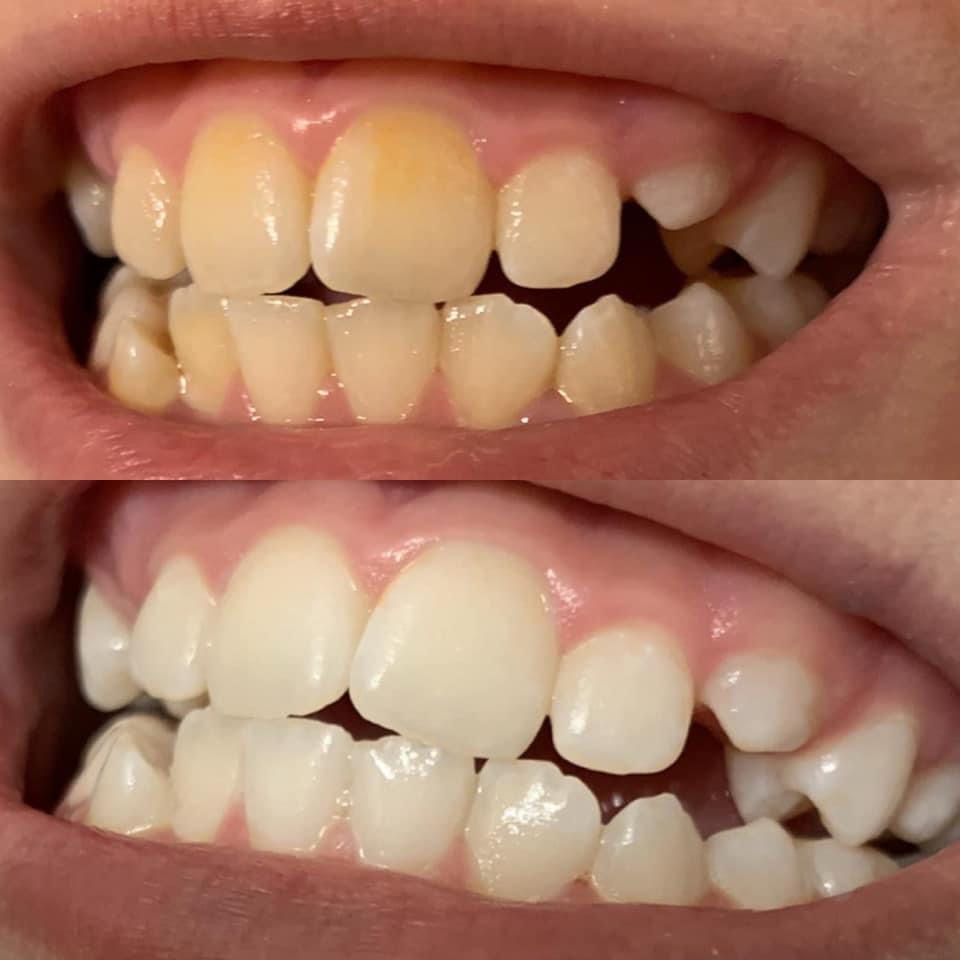 Whitening Toothpaste