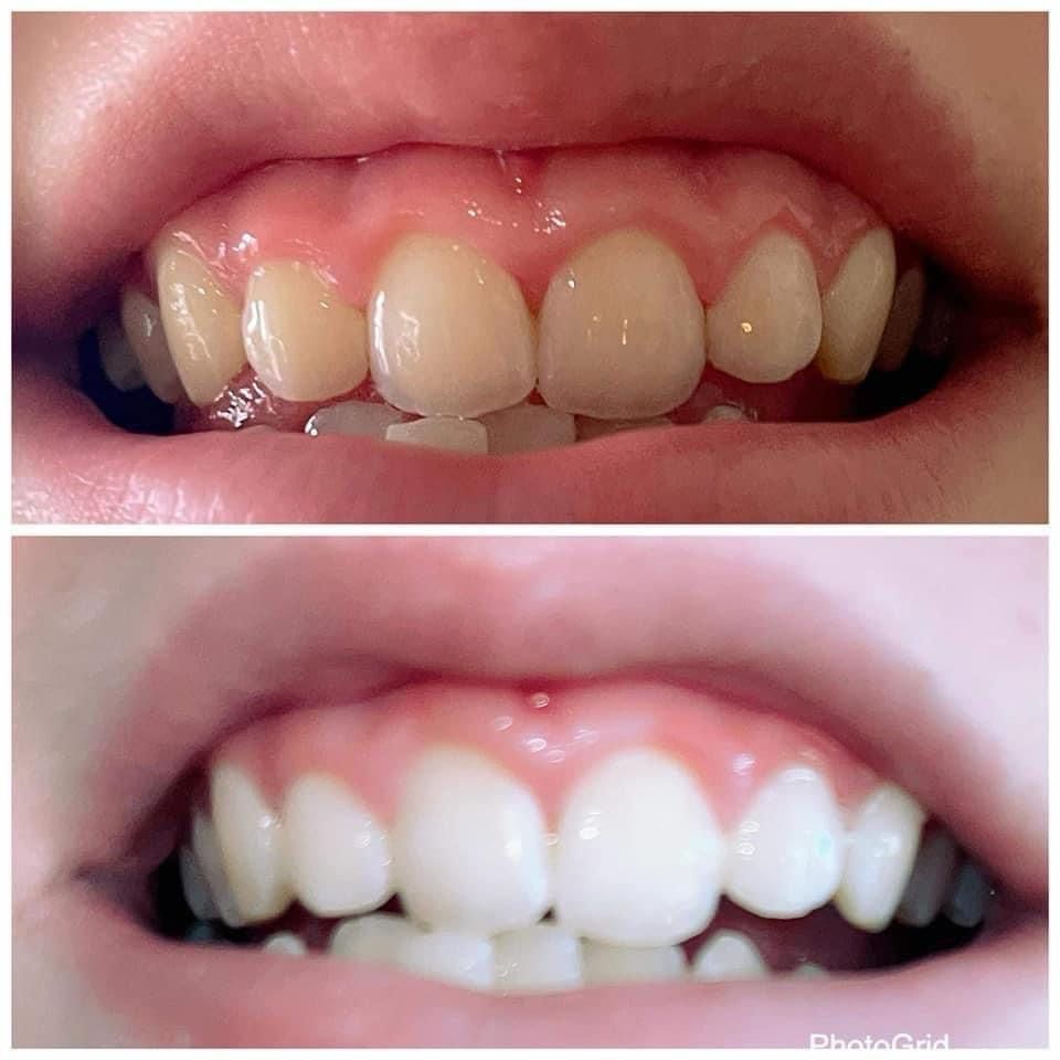 Whitening Toothpaste