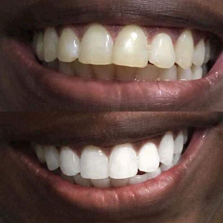 Whitening Toothpaste