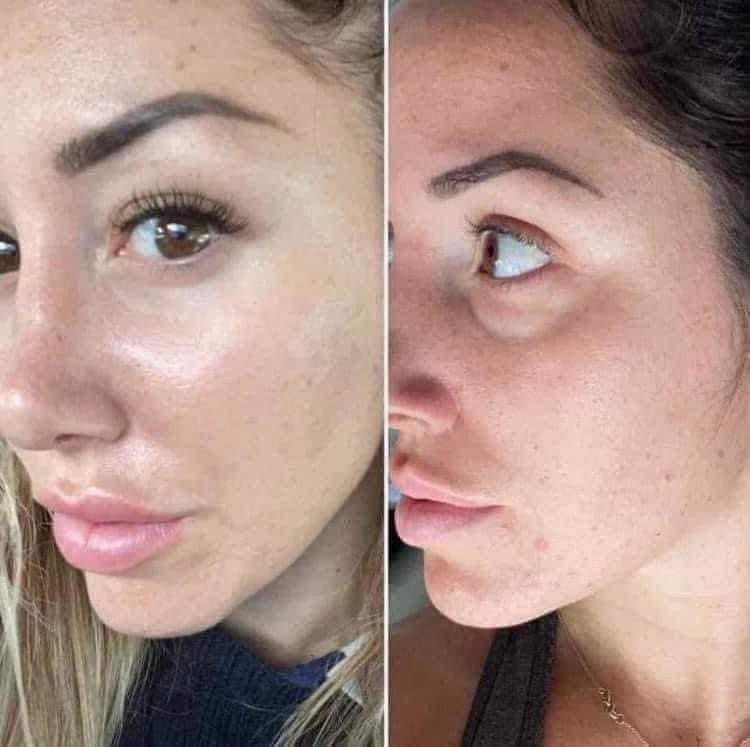 Vibrating Eye Tool With Complex Eye Cream