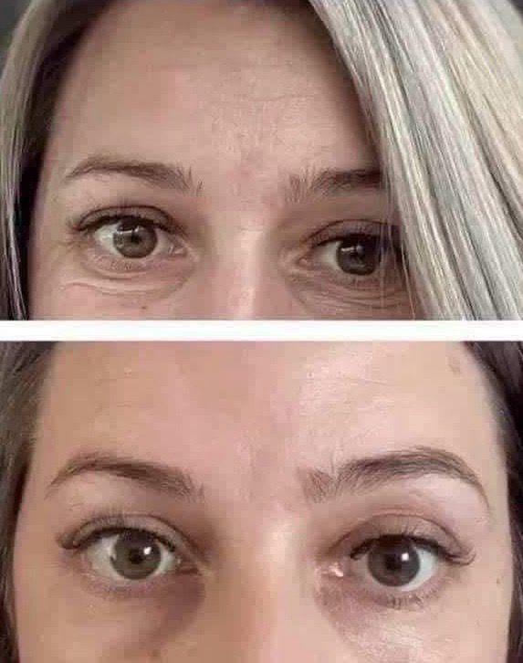 Vibrating Eye Tool With Complex Eye Cream