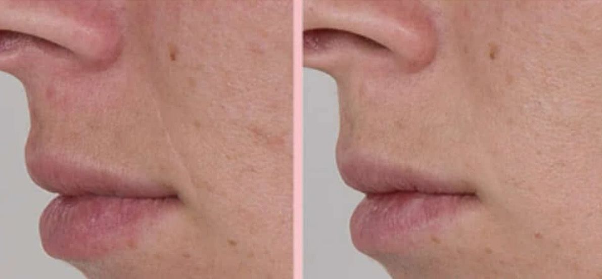 RED LIGHT THERAPY/MICRONEEDLING TOOL + Line Corrector + FREE Full Sized Tanner &amp; Detox Mask Samples