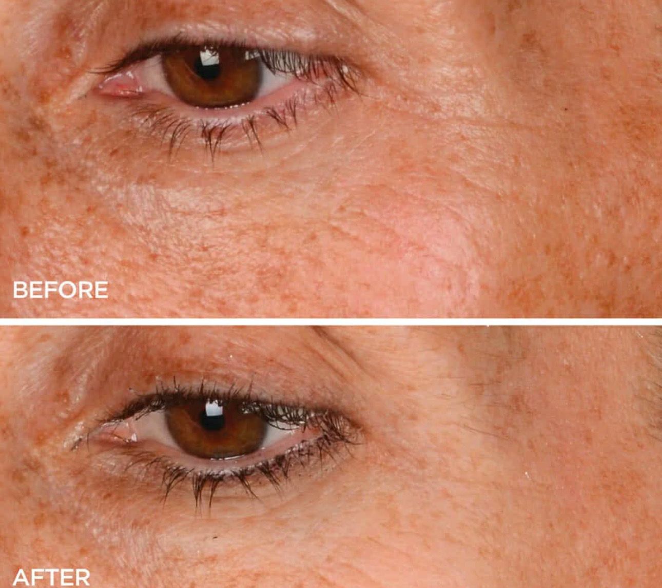 RED LIGHT THERAPY/MICRONEEDLING TOOL + Line Corrector + FREE Full Sized Tanner &amp; Detox Mask Samples