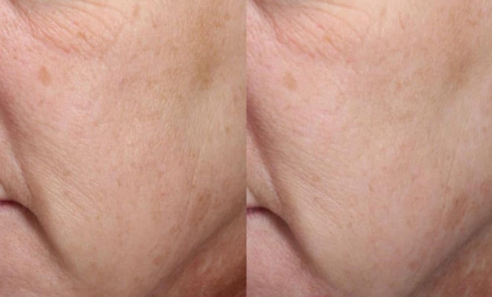 RED LIGHT THERAPY/MICRONEEDLING TOOL + Line Corrector + FREE Full Sized Tanner &amp; Detox Mask Samples