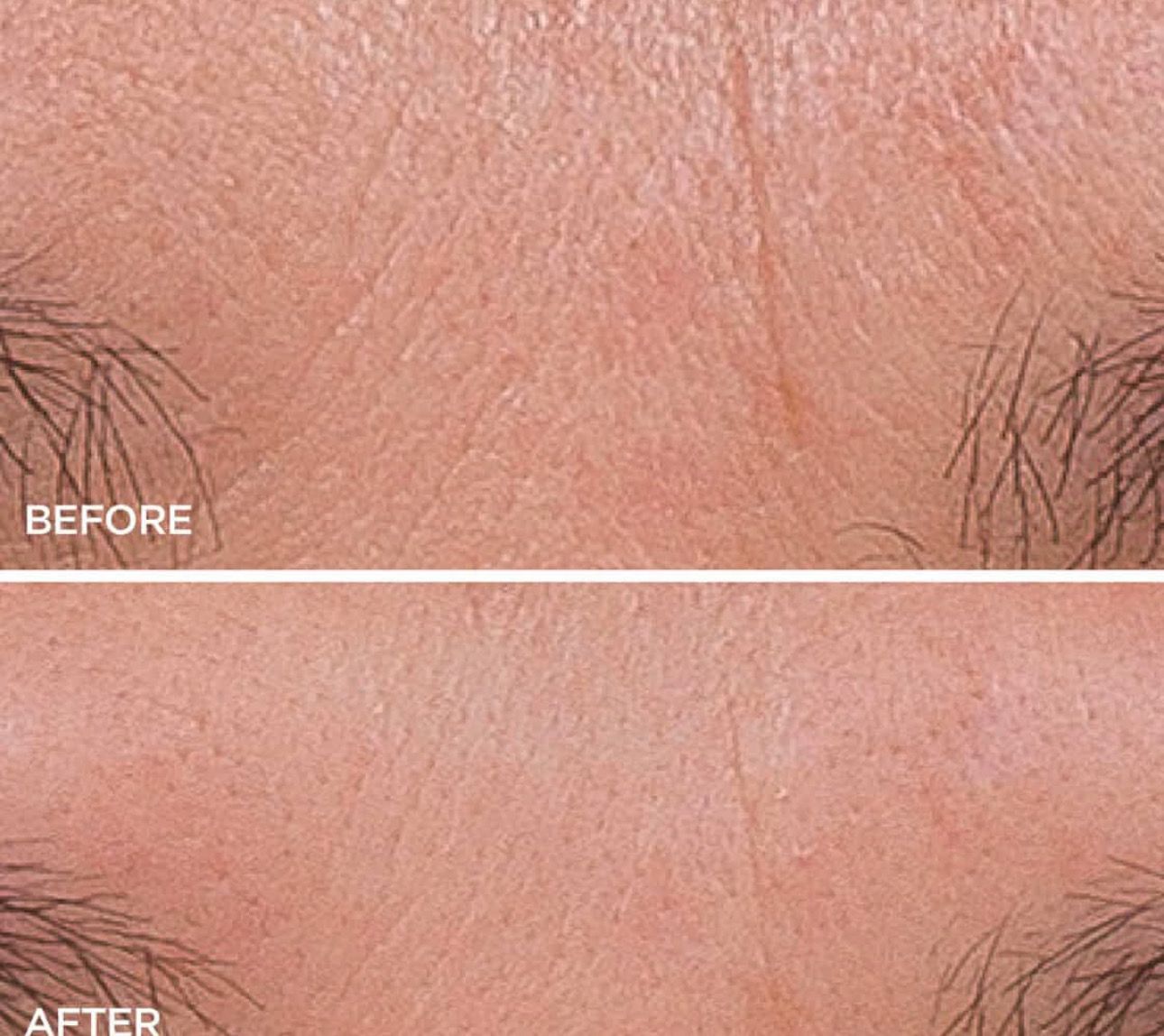 RED LIGHT THERAPY/MICRONEEDLING TOOL + Line Corrector + FREE Full Sized Tanner &amp; Detox Mask Samples