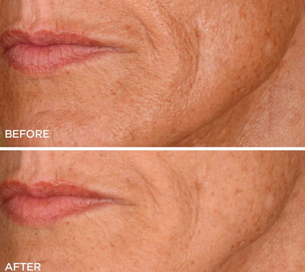 RED LIGHT THERAPY/MICRONEEDLING TOOL + Line Corrector + FREE Full Sized Tanner &amp; Detox Mask Samples