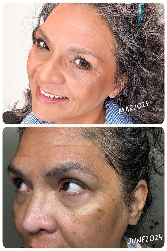 RED LIGHT THERAPY/MICRONEEDLING TOOL + Line Corrector + FREE Full Sized Tanner &amp; Detox Mask Samples