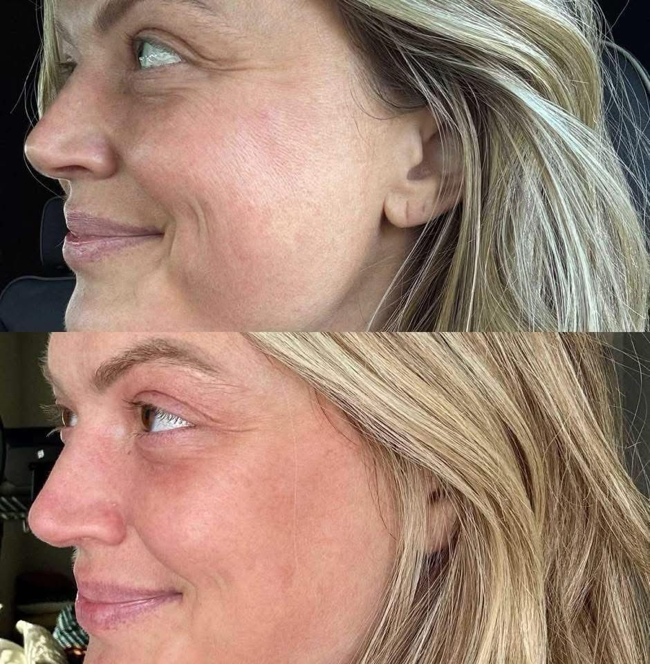 RED LIGHT THERAPY/MICRONEEDLING TOOL + Line Corrector + FREE Full Sized Tanner &amp; Detox Mask Samples