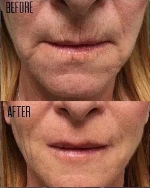 Tru Face Line Corrector